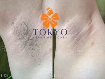 Tại sao khách hàng lại lựa chọn triệt lông công nghệ cao tại Tokyo Spa?